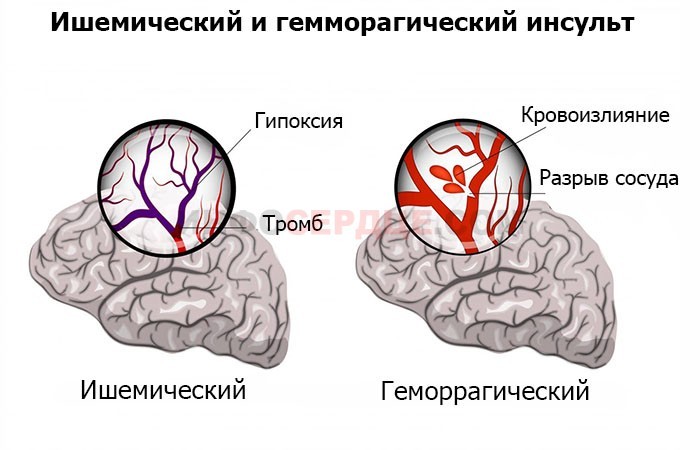 Микроинсульт фото лица