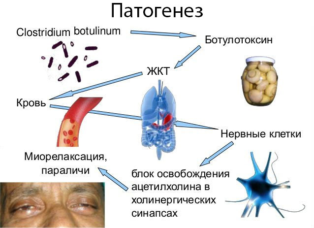 Патогенез ботулизма картинки