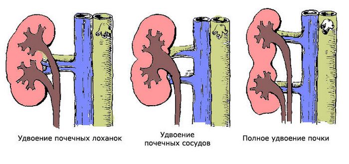 Почечная лоханка фото