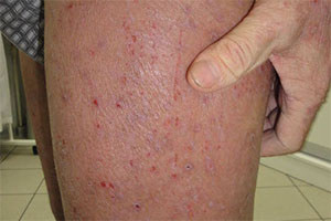 Аллергический дерматит на ноге