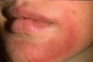 Аллергический дерматит на лице, около губ