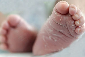 Ихтиоз кожи на ногах у ребенка