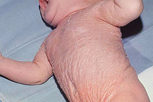 Ихтиоз кожи на теле у ребенка
